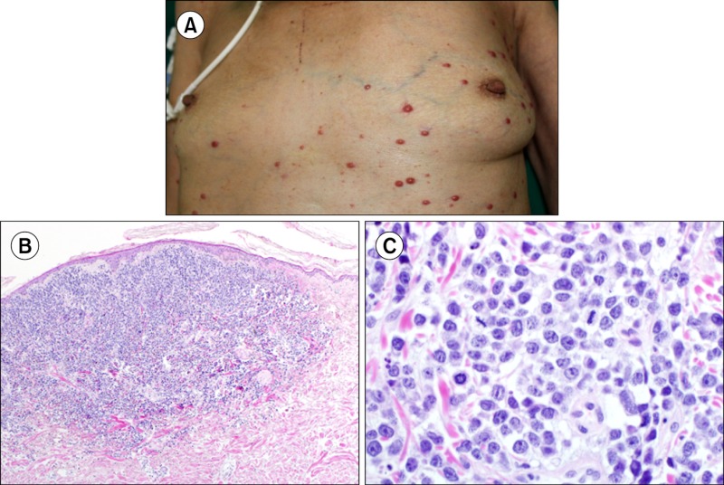 Cutaneous plasmacytoma.