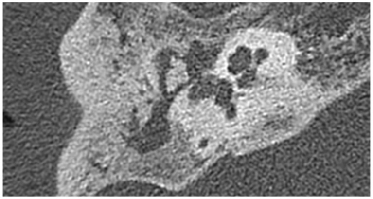 A case of delayed spontaneous aneurismal rupture after ear surgery under general anesthesia.
