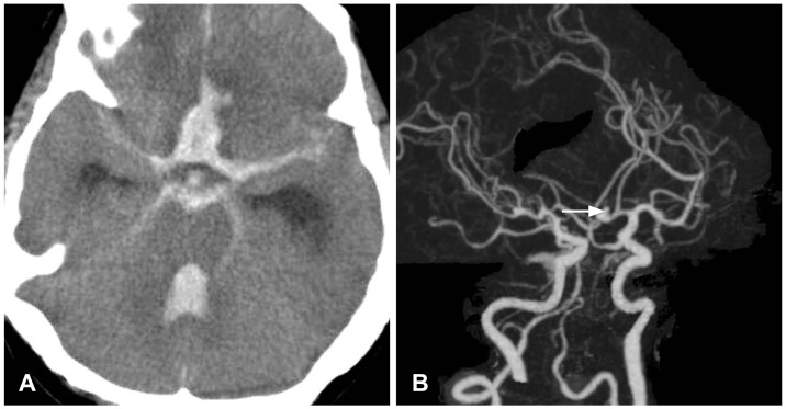 A case of delayed spontaneous aneurismal rupture after ear surgery under general anesthesia.
