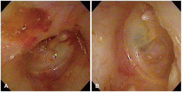 A case of delayed spontaneous aneurismal rupture after ear surgery under general anesthesia.