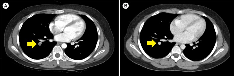 Thromboembolic events identified during diagnosis of germ cell tumors in 2 children.