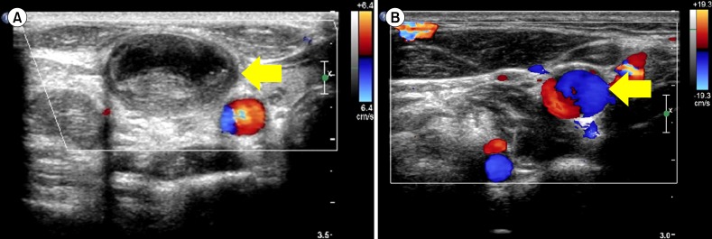 Thromboembolic events identified during diagnosis of germ cell tumors in 2 children.