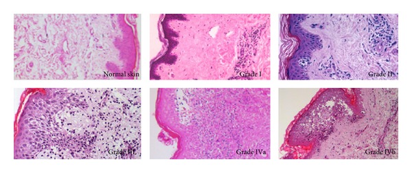 Review of the early diagnoses and assessment of rejection in vascularized composite allotransplantation.