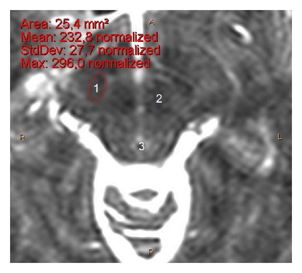 Anatomy of the human subthalamic nucleus: a combined morphometric study.