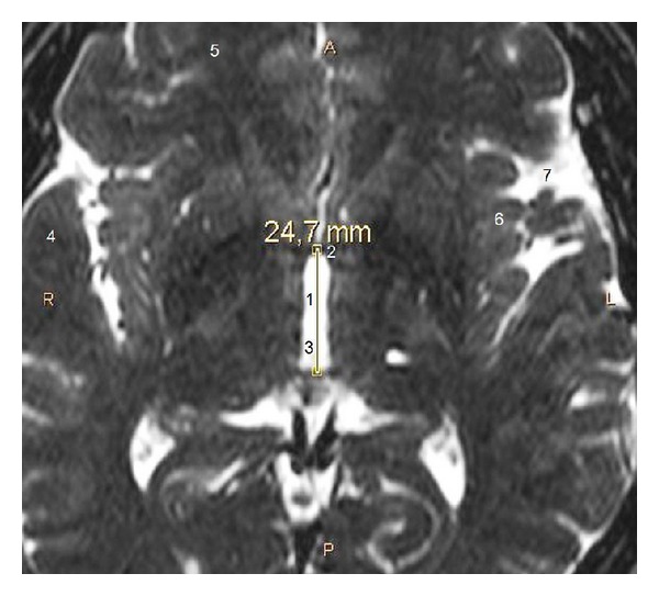 Anatomy of the human subthalamic nucleus: a combined morphometric study.