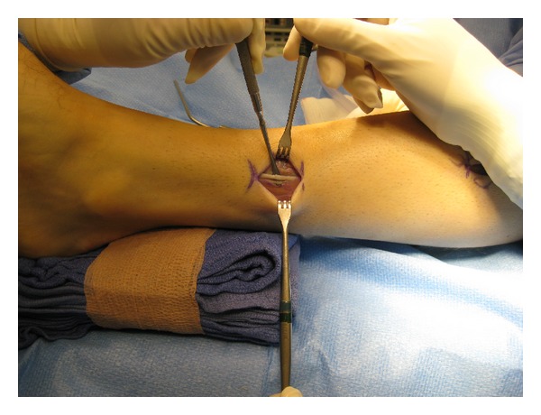 Open and arthroscopic surgical anatomy of the ankle.
