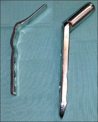 A simple technique for adjustment of the femoral offset at the site of hip spacer implantation.
