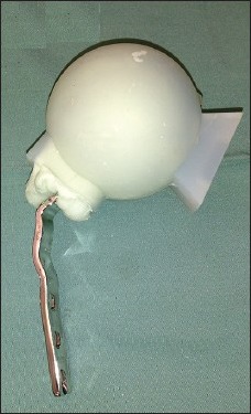 A simple technique for adjustment of the femoral offset at the site of hip spacer implantation.