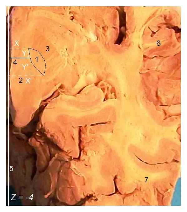 Anatomy of the human subthalamic nucleus: a combined morphometric study.
