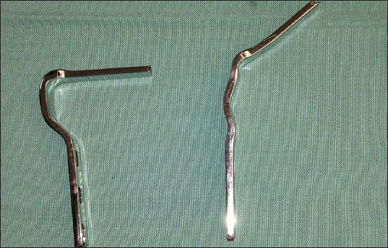 A simple technique for adjustment of the femoral offset at the site of hip spacer implantation.
