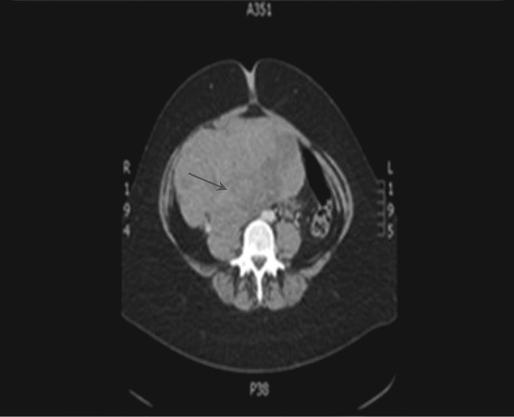 Ectopic prolactin secretion secondary to an ovarian tumour.