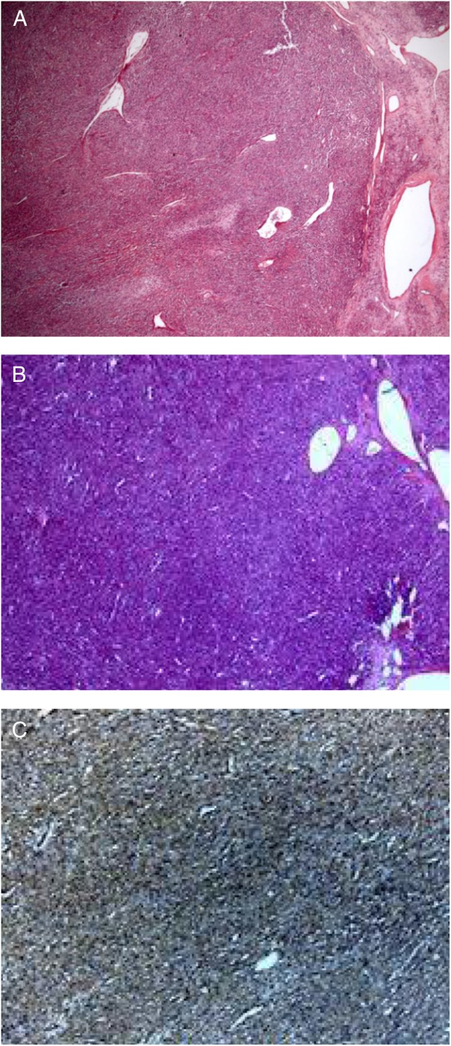 Non-islet cell tumor-induced hypoglycemia: a report of five cases and brief review of the literature.