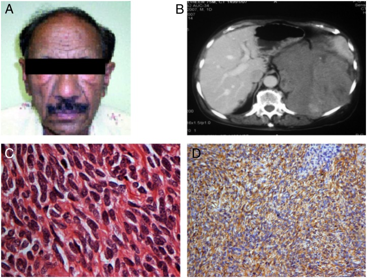 Non-islet cell tumor-induced hypoglycemia: a report of five cases and brief review of the literature.