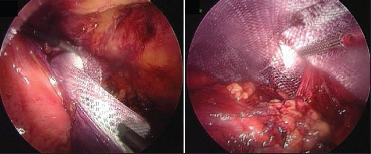 Laparoscopic Inguinal Hernia Repair in a Developing Nation: Short-term Outcomes in 103 Consecutive Procedures.