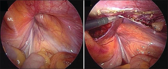 Laparoscopic Inguinal Hernia Repair in a Developing Nation: Short-term Outcomes in 103 Consecutive Procedures.