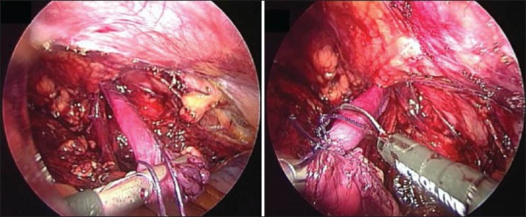 Laparoscopic Inguinal Hernia Repair in a Developing Nation: Short-term Outcomes in 103 Consecutive Procedures.