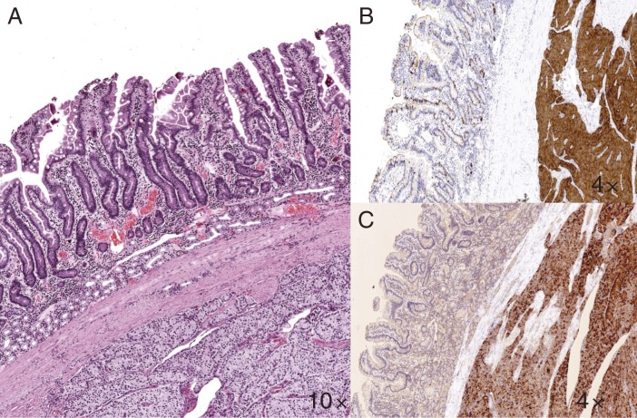 Medullary thyroid carcinoma and duodenal calcitonin-secreting neuroendocrine tumour: more than coincidence?