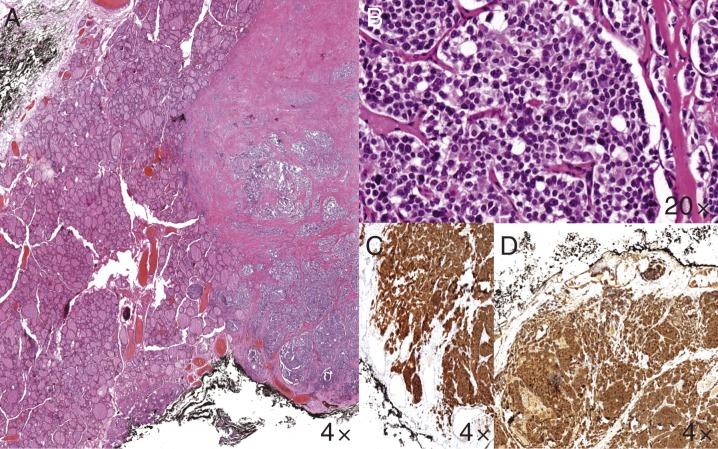 Medullary thyroid carcinoma and duodenal calcitonin-secreting neuroendocrine tumour: more than coincidence?