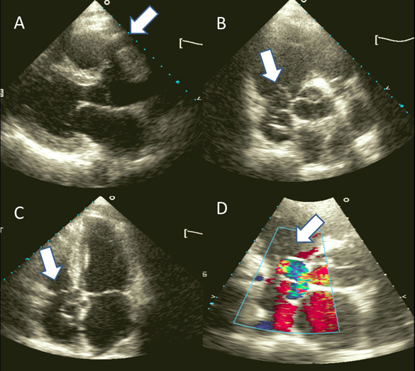 Coronary Artery to Right Atrium Fistula Associated With First Degree Atrioventricular Block: A Rare Association.