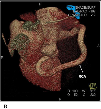 Coronary Artery to Right Atrium Fistula Associated With First Degree Atrioventricular Block: A Rare Association.