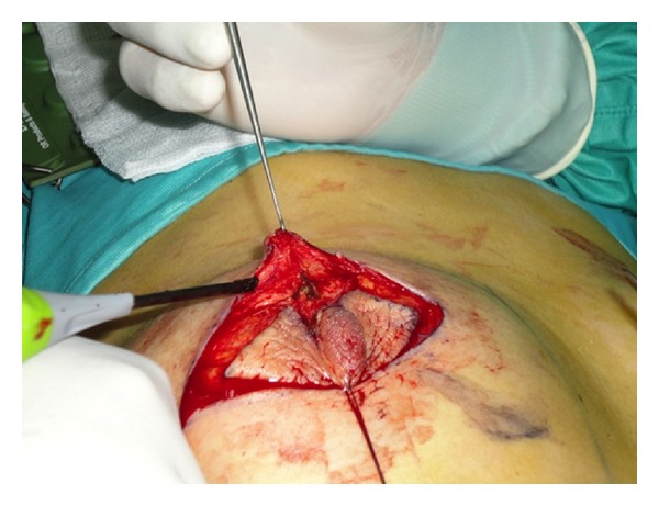 Skin-sparing mastectomy with immediate breast and nipple reconstruction: a new technique of nipple reconstruction.