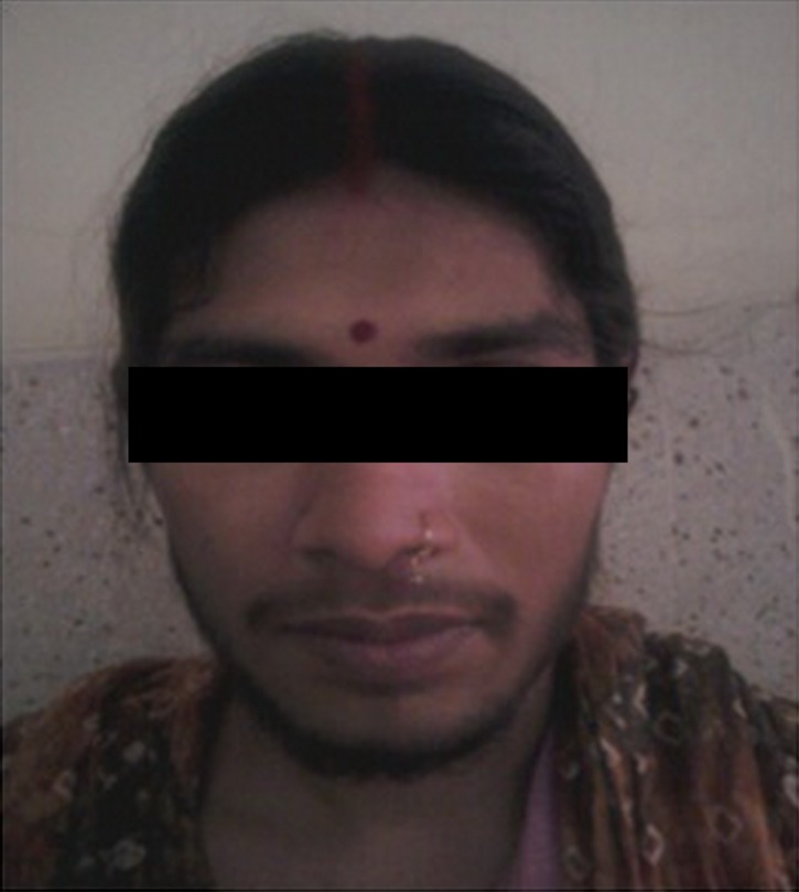 Steroid cell tumor: a rare cause of hirsutism in a female.