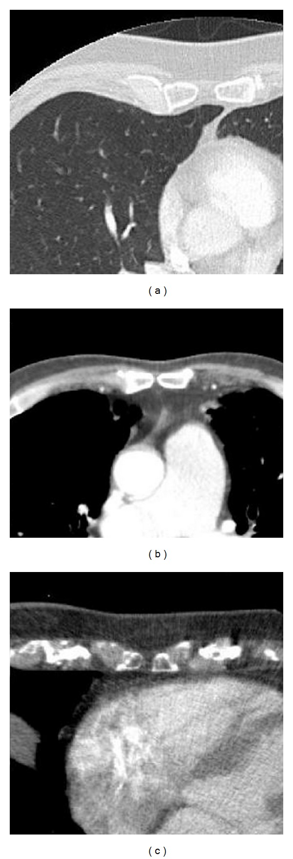 Relationship of sternal foramina to vital structures of the chest: a computed tomographic study.