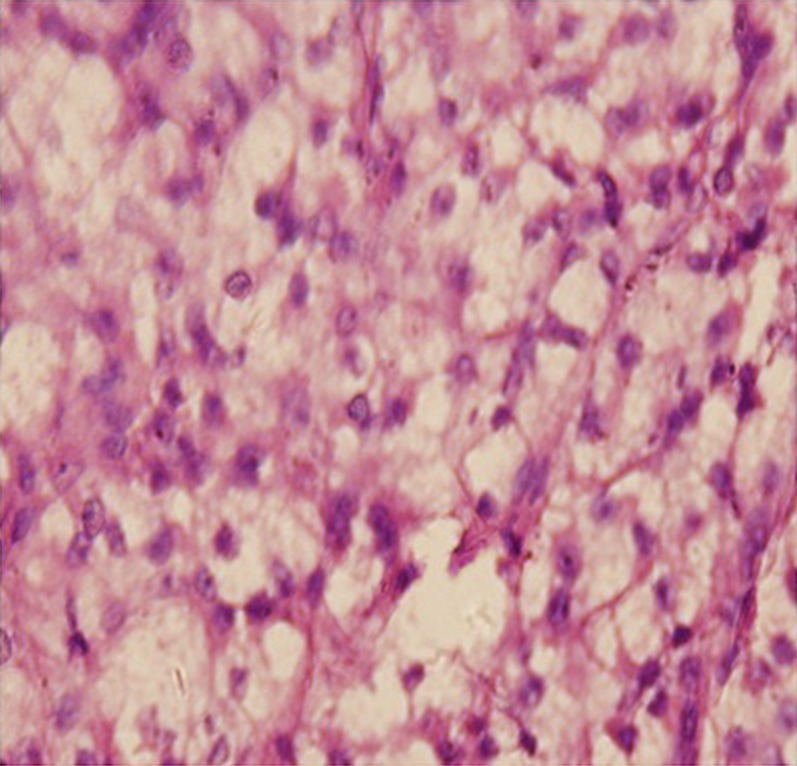 Steroid cell tumor: a rare cause of hirsutism in a female.