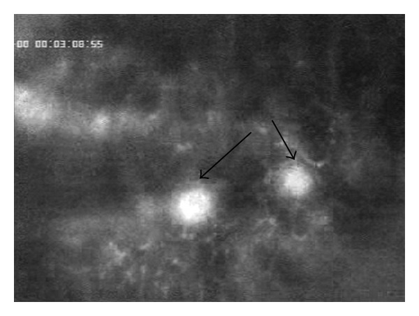 Intravital microscopic research of microembolization with degradable starch microspheres.