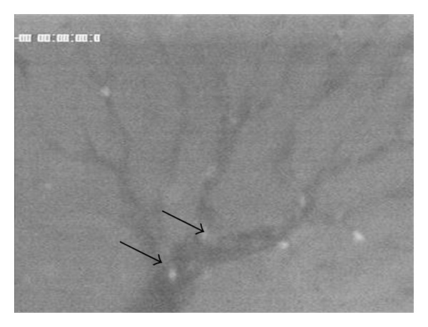 Intravital microscopic research of microembolization with degradable starch microspheres.