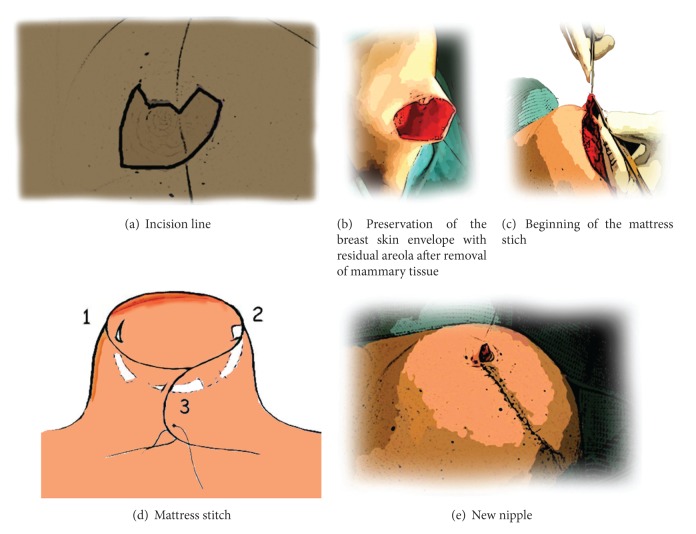 Skin-sparing mastectomy with immediate breast and nipple reconstruction: a new technique of nipple reconstruction.