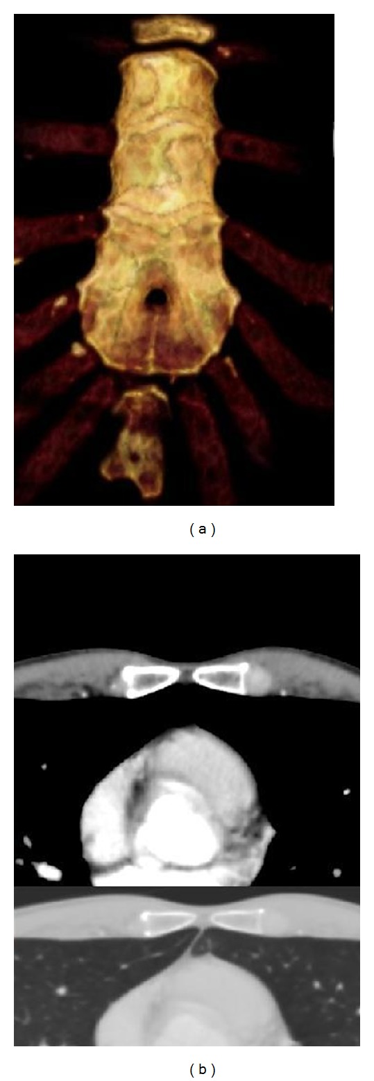 Relationship of sternal foramina to vital structures of the chest: a computed tomographic study.