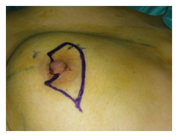Skin-sparing mastectomy with immediate breast and nipple reconstruction: a new technique of nipple reconstruction.
