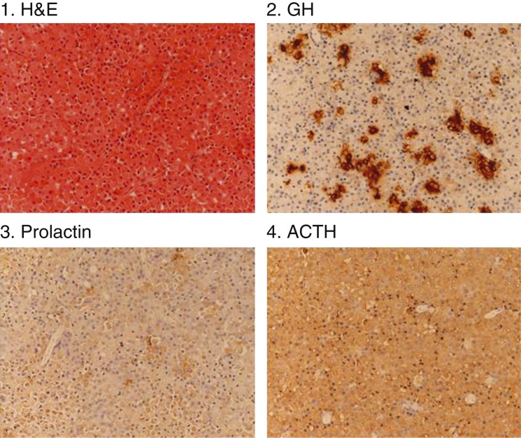 Pasireotide therapy in a rare and unusual case of plurihormonal pituitary macroadenoma.