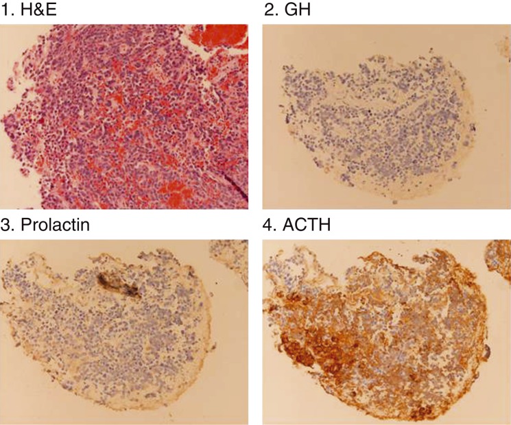 Pasireotide therapy in a rare and unusual case of plurihormonal pituitary macroadenoma.