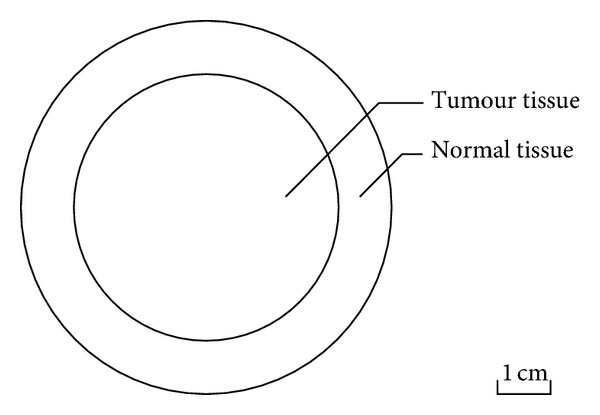 A mathematical model for thermosensitive liposomal delivery of Doxorubicin to solid tumour.