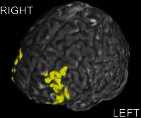 Psychopharmacological Practice: The DSM Versus The Brain.