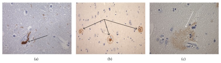 P-Glycoprotein Altered Expression in Alzheimer's Disease: Regional Anatomic Variability.