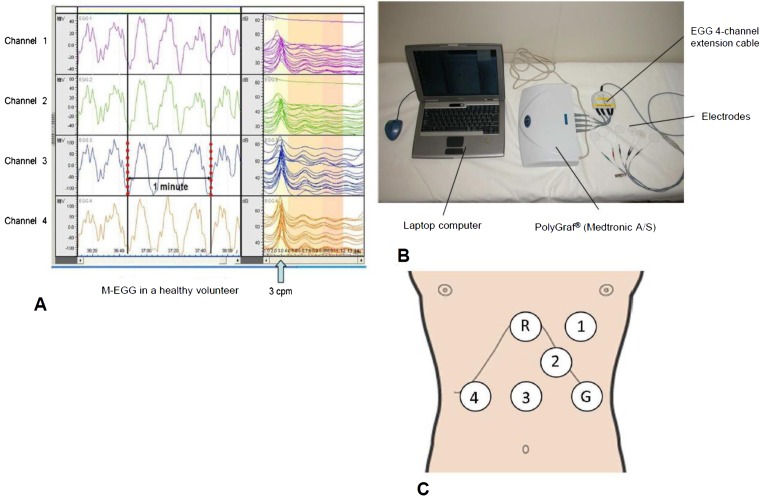 Current status of multichannel electrogastrography and examples of its use.