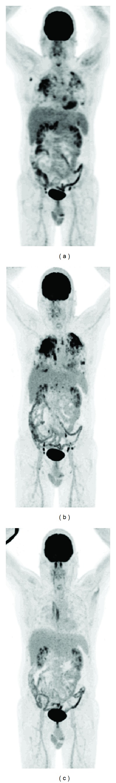 The use of (18)F-FDG-PET/CT for diagnosis and treatment monitoring of inflammatory and infectious diseases.