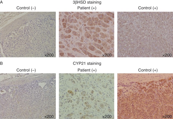 Benign adrenal adenomas secreting excess mineralocorticoids and glucocorticoids.