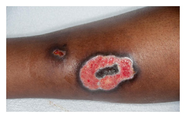 Burn injuries resulting from hot water bottle use: a retrospective review of cases presenting to a regional burns unit in the United kingdom.