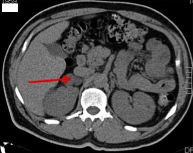 Benign adrenal adenomas secreting excess mineralocorticoids and glucocorticoids.