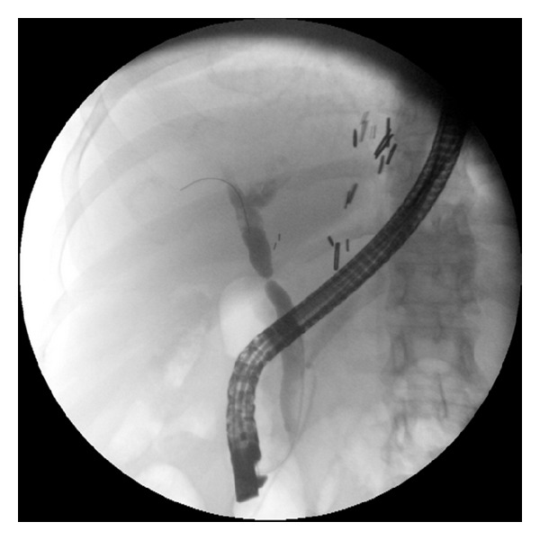 Effectiveness and safety of endoscopic treatment of benign biliary strictures using a new fully covered self expandable metal stent.