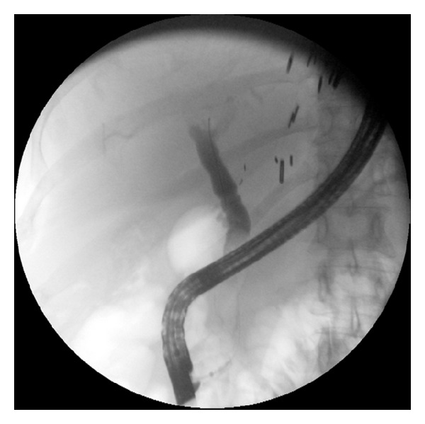 Effectiveness and safety of endoscopic treatment of benign biliary strictures using a new fully covered self expandable metal stent.