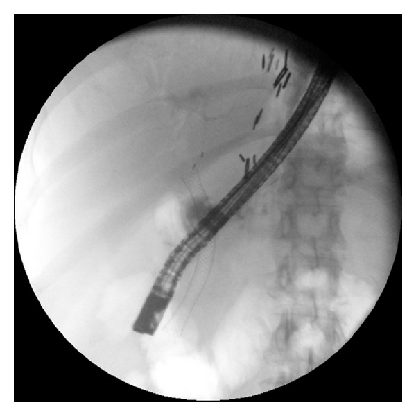 Effectiveness and safety of endoscopic treatment of benign biliary strictures using a new fully covered self expandable metal stent.