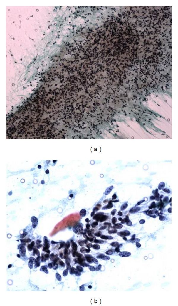 Cytological and Pathological Correlation of FNAC in Assessing Breast Lumps and Axillary Lymph Node Swellings in a Public Sector Hospital in India.