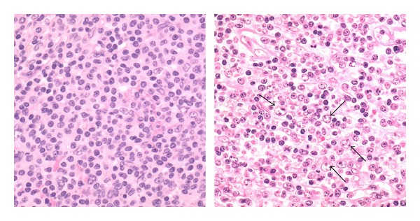 CD79B and MYD88 Mutations in Splenic Marginal Zone Lymphoma.