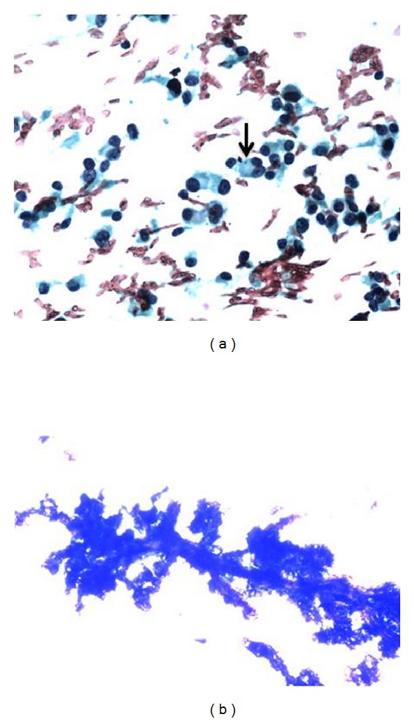 Cytological and Pathological Correlation of FNAC in Assessing Breast Lumps and Axillary Lymph Node Swellings in a Public Sector Hospital in India.