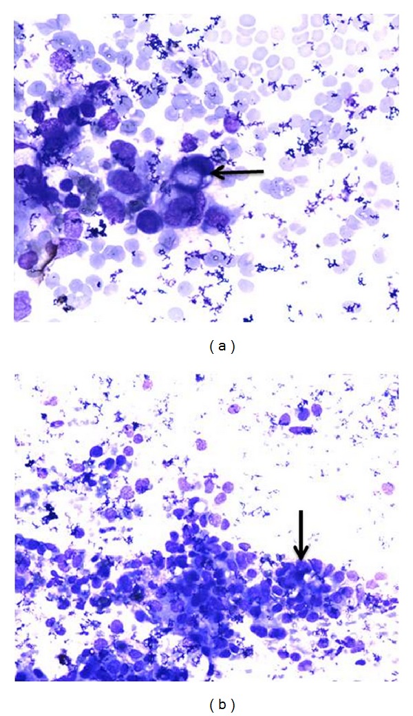 Cytological and Pathological Correlation of FNAC in Assessing Breast Lumps and Axillary Lymph Node Swellings in a Public Sector Hospital in India.